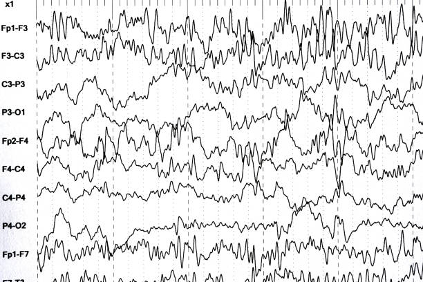 istock Brain wave patterns on electroencephalogram, EEG of the pediatric patients, problems in the electrical activity of the brain. 973878170