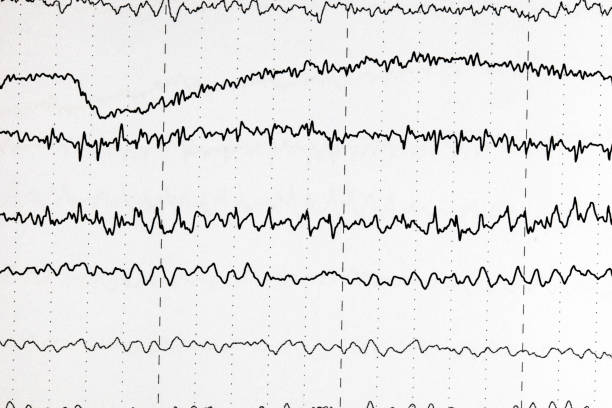 Foto de Padrões De Ondas Cerebrais No Eletroencefalograma Eeg De