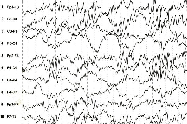 istock Brain wave patterns on electroencephalogram, EEG of the pediatric patients, problems in the electrical activity of the brain. 973881372