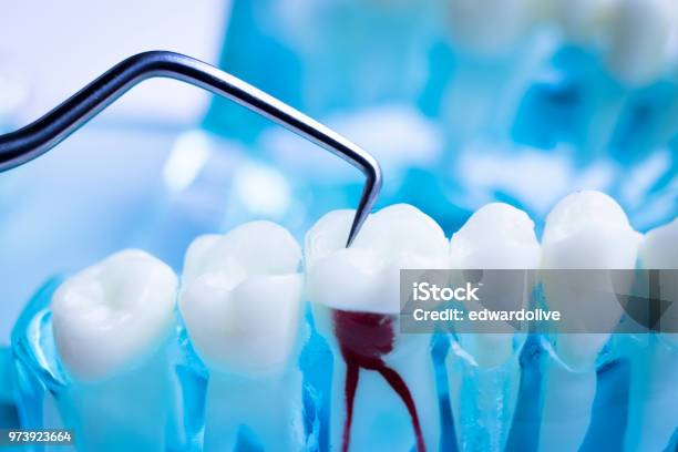 Zahnarzt Reinigung Zähne Mit Titan Metall Zahn Pick Instrument Um Plaque Und Karies Zu Entfernen Stockfoto und mehr Bilder von Zahnwurzel