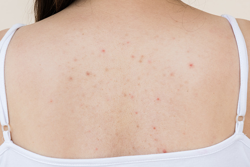 Problema de salud, acné de joven de primer plano sobre su espalda. photo