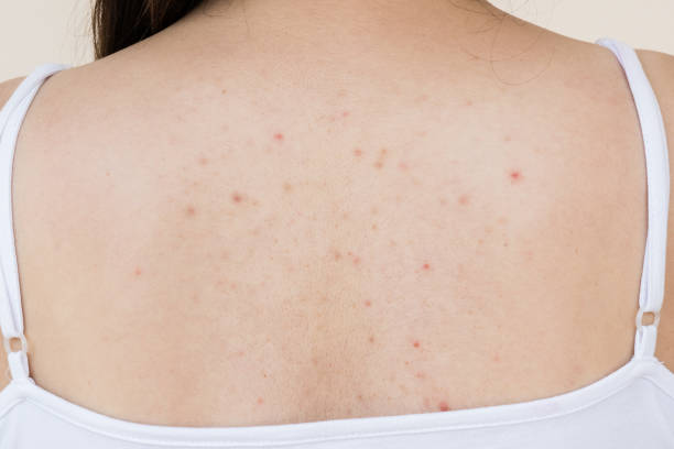 Health problem, closeup young girl acne on her back. Health problem, closeup young girl acne on her back. human back stock pictures, royalty-free photos & images