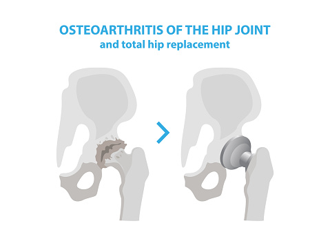 Osteoarthritis Of The Hip Joint And Hip Replacement Surgery Medical ...