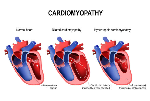 illustrazioni stock, clip art, cartoni animati e icone di tendenza di cardiomiopatia ipertrofica, cardiomiopatia dilatata e - cross section illustrations