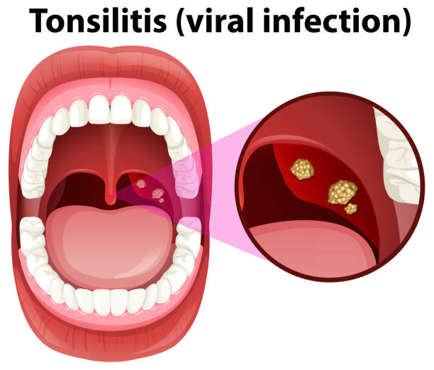 A Human Mouth Tonsillitis Infection A Human Mouth Tonsillitis Infection illustration tonsil stock illustrations