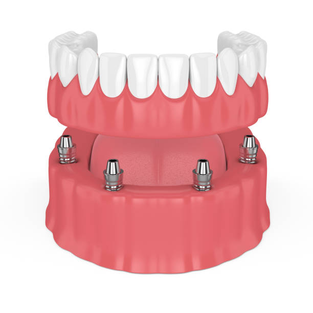 istock 3d render of removable full implant denture 974670776