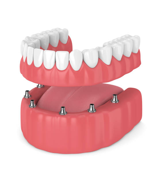 3d render de la prótesis dental removible implantes completo - premolar fotografías e imágenes de stock