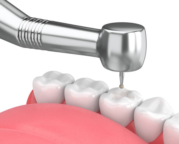 istock 3d render of jaw with dental handpiece and drill 974672272