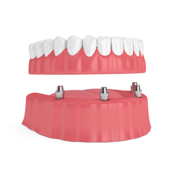 istock 3d render of removable full implant denture 974672564