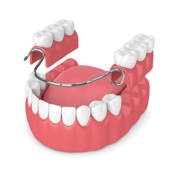 3d render abnehmbare teilprothese - dentures stock-fotos und bilder