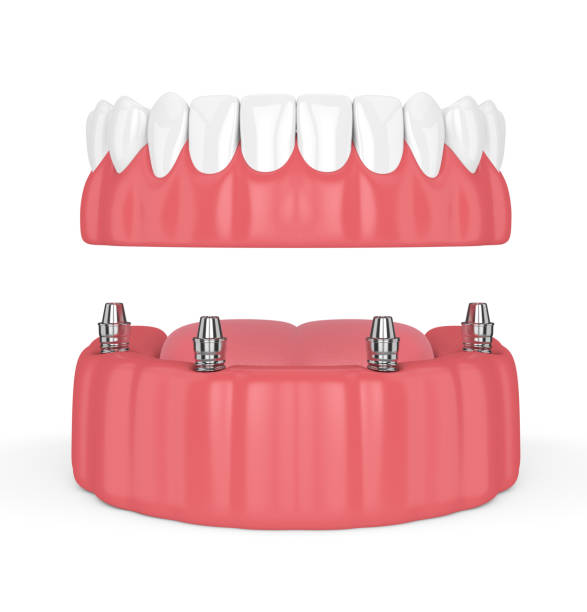 istock 3d render of removable full implant denture 974676126