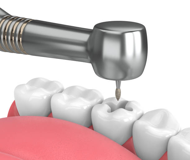 istock 3d render of jaw with dental handpiece and drill 974680122