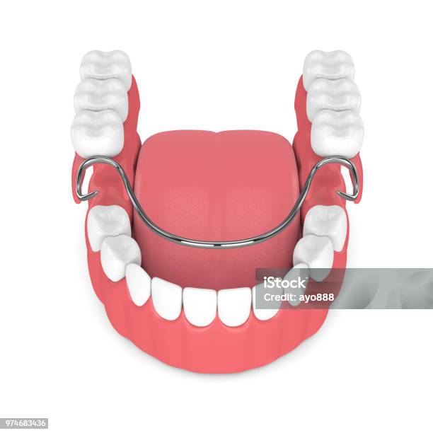 Photo libre de droit de Rendu 3d De Prothèse Partielle Amovible banque d'images et plus d'images libres de droit de Vue partielle - Vue partielle, Dentier, Aboutissement