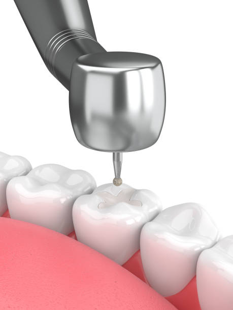 istock 3d render of jaw with dental handpiece and drill 974687734