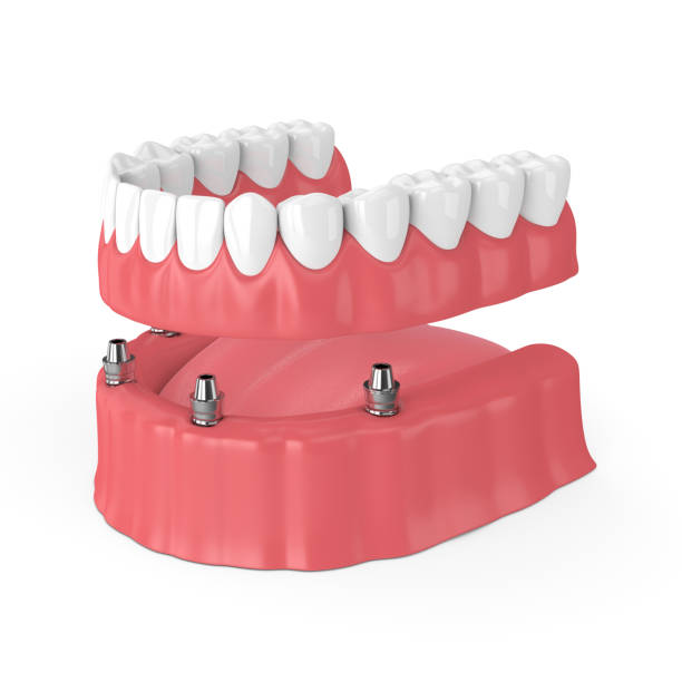 3d render abnehmbare voll implantat-prothese - dentures stock-fotos und bilder