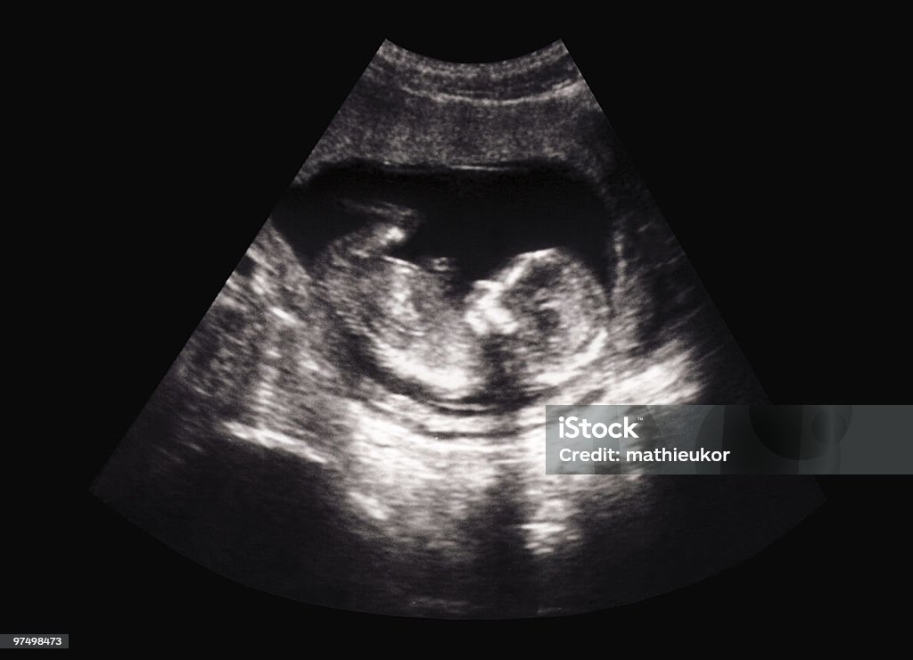Fetus ultrasound  Ultrasound Stock Photo
