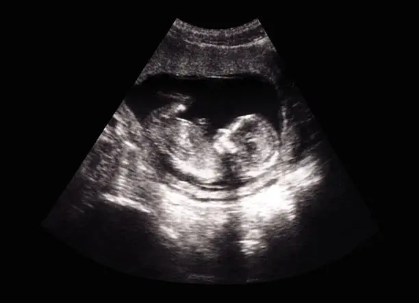 Photo of Fetus ultrasound
