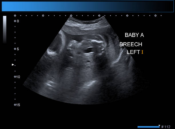 istock Identical twin boys obstetrical ultrasound 975030328