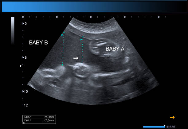 identyczne bliźniacze chłopcy położnictwa usg - twin fetus uterus human pregnancy zdjęcia i obrazy z banku zdjęć