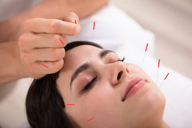 istock Beautiful Woman Getting Acupuncture Treatment 975131840