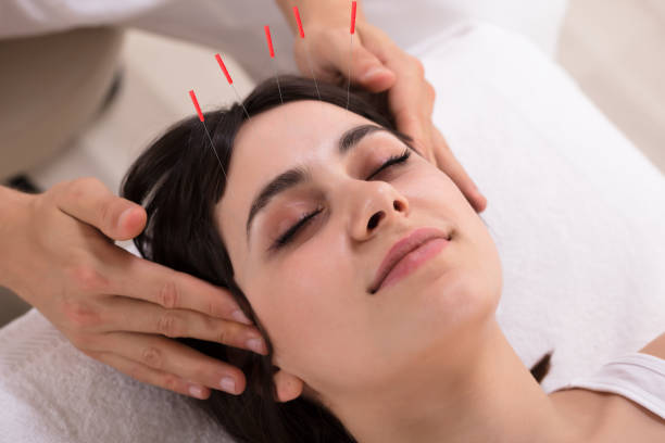 Woman Receiving Acupuncture Treatment Relaxed Young Woman Receiving Acupuncture Treatment In Beauty Spa acupuncture photos stock pictures, royalty-free photos & images