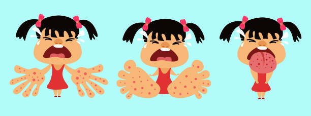 HFMD children infected. hand foot and mouth disease. Girl infected enterovirus. HFMD children infected. hand foot and mouth disease. Girl infected enterovirus. Cartoon vector illustration hand foot and mouth disease stock illustrations