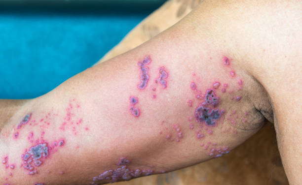 Detail of right arm skin with Herpes Zoster (Shingles) on man's arm. Shingles, also known as herpes zoster, is a viral disease characterized by a painful skin rash with blisters in a localized area. Typically the rash occurs in a single, wide stripe either on the left or right side of the body or face.Two to four days before the rash occurs there may be tingling or local pain in the area. shingles rash stock pictures, royalty-free photos & images