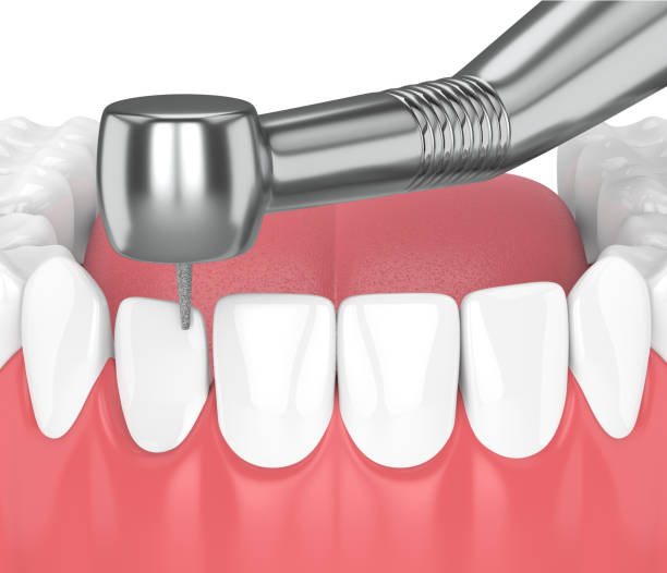 istock 3d render of jaw with dental handpiece and drill 976788204