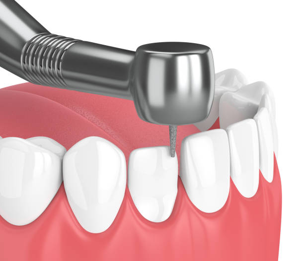 istock 3d render of jaw with dental handpiece and drill 976789742