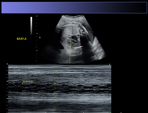 Anatomy scan of twin gestation 30 weeks 2 days, monochorionic diamniotic. Fetal anatomy and gastrointestinal tract visualized with normal appearance, kidneys, bladder, stomach. Male fetus genitalia. No fetal anomalies were detected.  Posterior placenta previa. Concordant growth rate of both twins with no evidence of TTTS. Normal BPPs and Dopplers