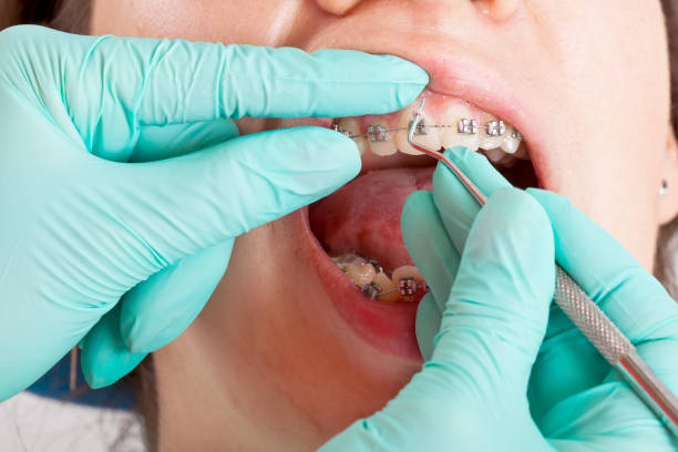 istock Boy with braces. Dental check up 977369400