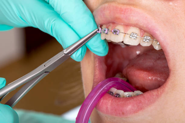 istock Dental braces close up 978149250