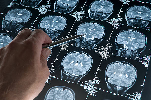 scansione rm cerebrale di testa, cranio con mano che indica - tumore foto e immagini stock