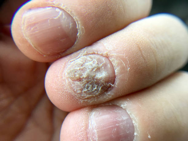 большой крупным планом гриб инфекции на ногтях руки, палец с онихомикозом, грибковая инфекция на ногтях. - discolored стоковые фото и изображения