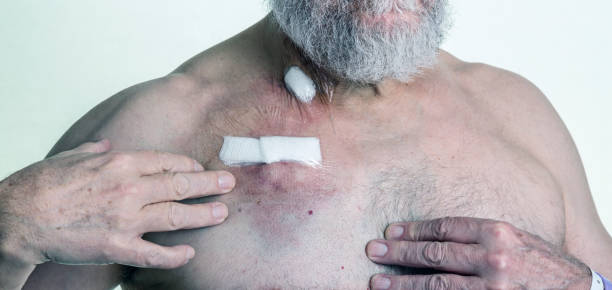 ältere erwachsene mann krebs patienten subkutane chemotherapie iv brust port katheter - iv bruise stock-fotos und bilder