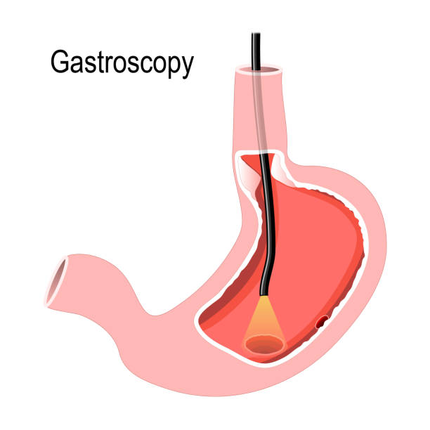menschlichen magen mit endoskop - endoskop stock-grafiken, -clipart, -cartoons und -symbole