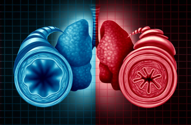 천식 건강 진단 - bronchitis 뉴스 사진 이미지