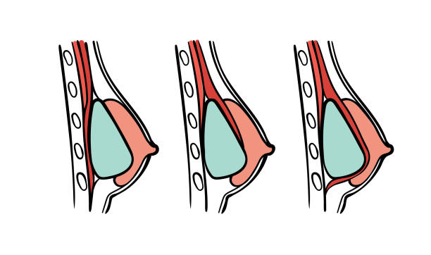 breast implants positions chart Vector illustration of plastic surgery types - breast implants positions chart: submuscular, subglandular and subfacial implantology. silicone implants stock illustrations
