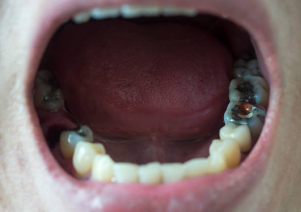 istock unhealthy tooth with dental caries 980265998