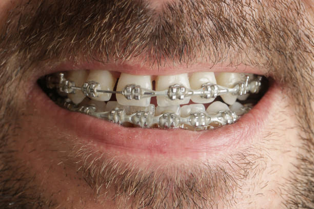 istock Young man with braces on teeth, close up, straightening teeth concept 980383816