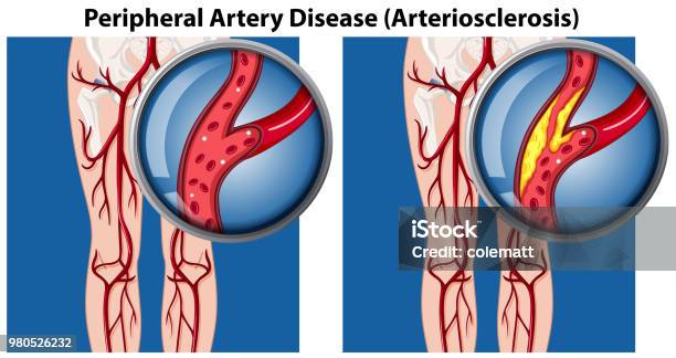 A Comparison Of Peripheral Artery Disease Stock Illustration - Download Image Now - Artery, Illness, Atherosclerosis