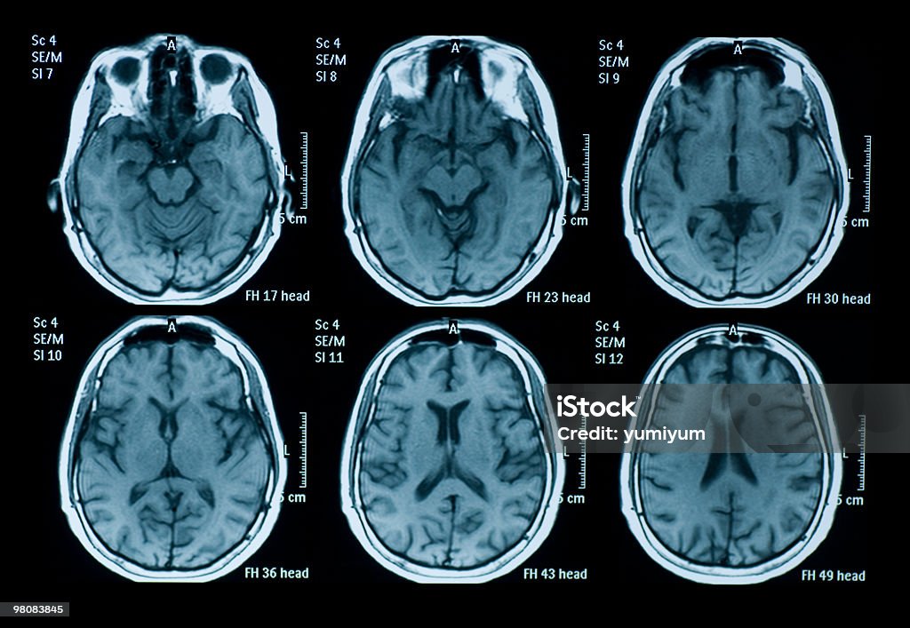 MRI del cerebro - Foto de stock de Escáner IRM libre de derechos