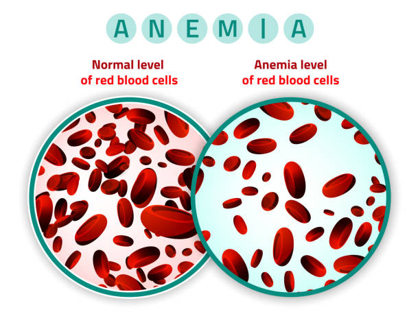 Anemia level of blood cells Normal level of red blood cells in comparison with iron deficiency anemia level. Medical and healthcare concept. Vector illustration isolated on a white background. anemia diagram stock illustrations