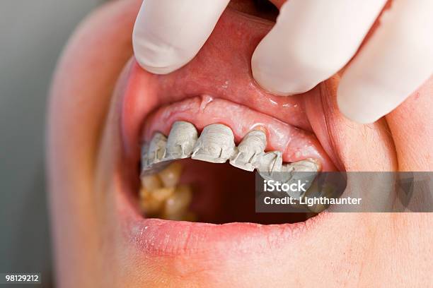 Foto de Parcial De Uma Determinada Pessoa De Dentadura e mais fotos de stock de Consultório Dentário - Consultório Dentário, Dentadura, Dente Humano