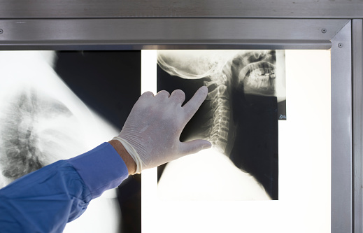 Cropped image of male surgeon pointing at neck x-ray. Close-up of hand examining medical report. He is wearing medical glove in hospital.