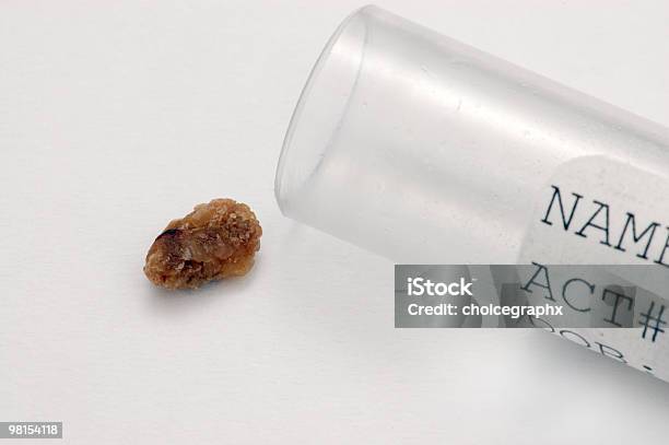 Kidney Stone Stock Photo - Download Image Now - Kidney Stone, Color Image, Colored Background