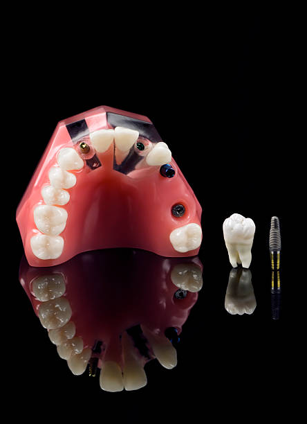 istock Wisdom Tooth, Dental Implant and Plastic Model 98226084