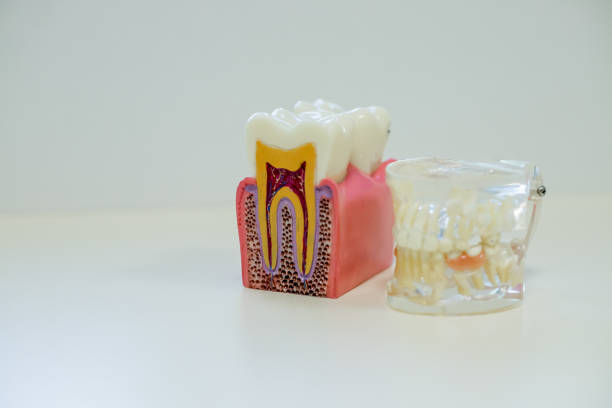 istock White teeth model and tooth model without caries on white background. Dental care concept. 982283782