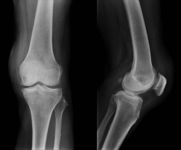 istock X-ray image of normal old age Knee 982563582