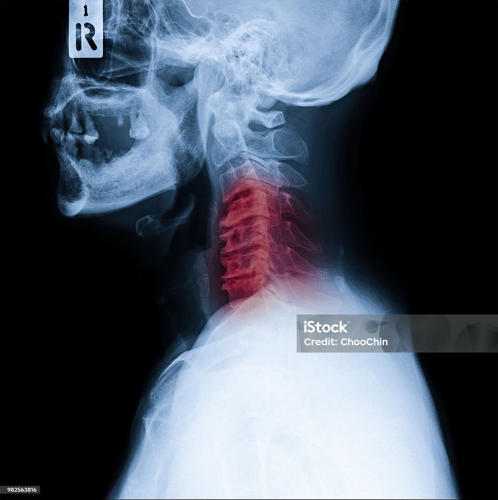 X-ray of neck and cervical spine side view. Image of radiography from patient who have neck pain, nerve root compression, numbness at arm hand wrist or finger Neck Stock Photo